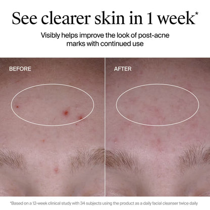 Neutrogena® Evenly Clear™ Acne Cleanser, 9.1 Oz - US 4397